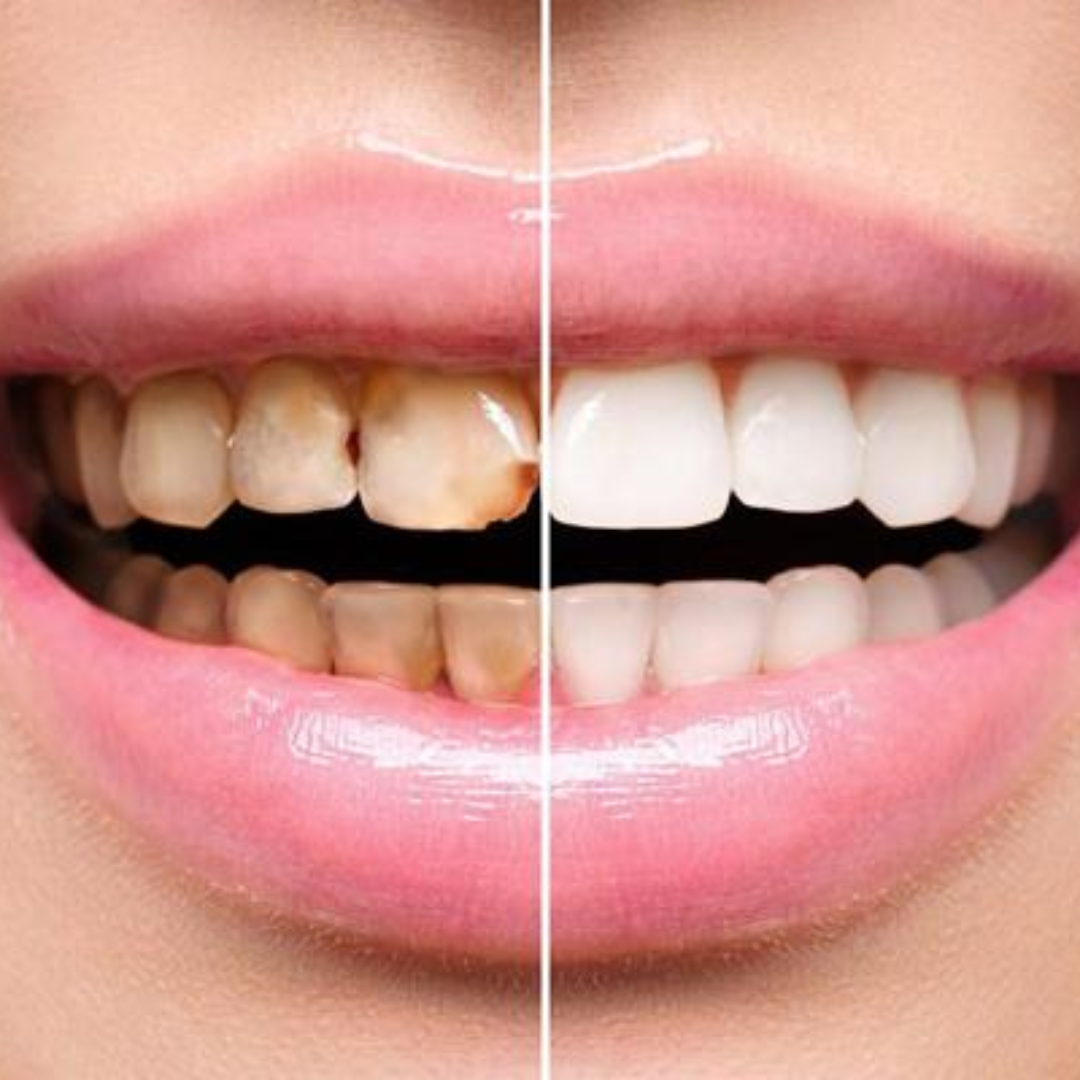 dental impamnt (2)