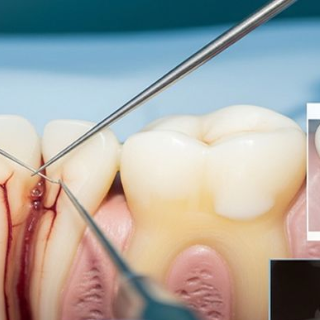 dental impamnt (5)