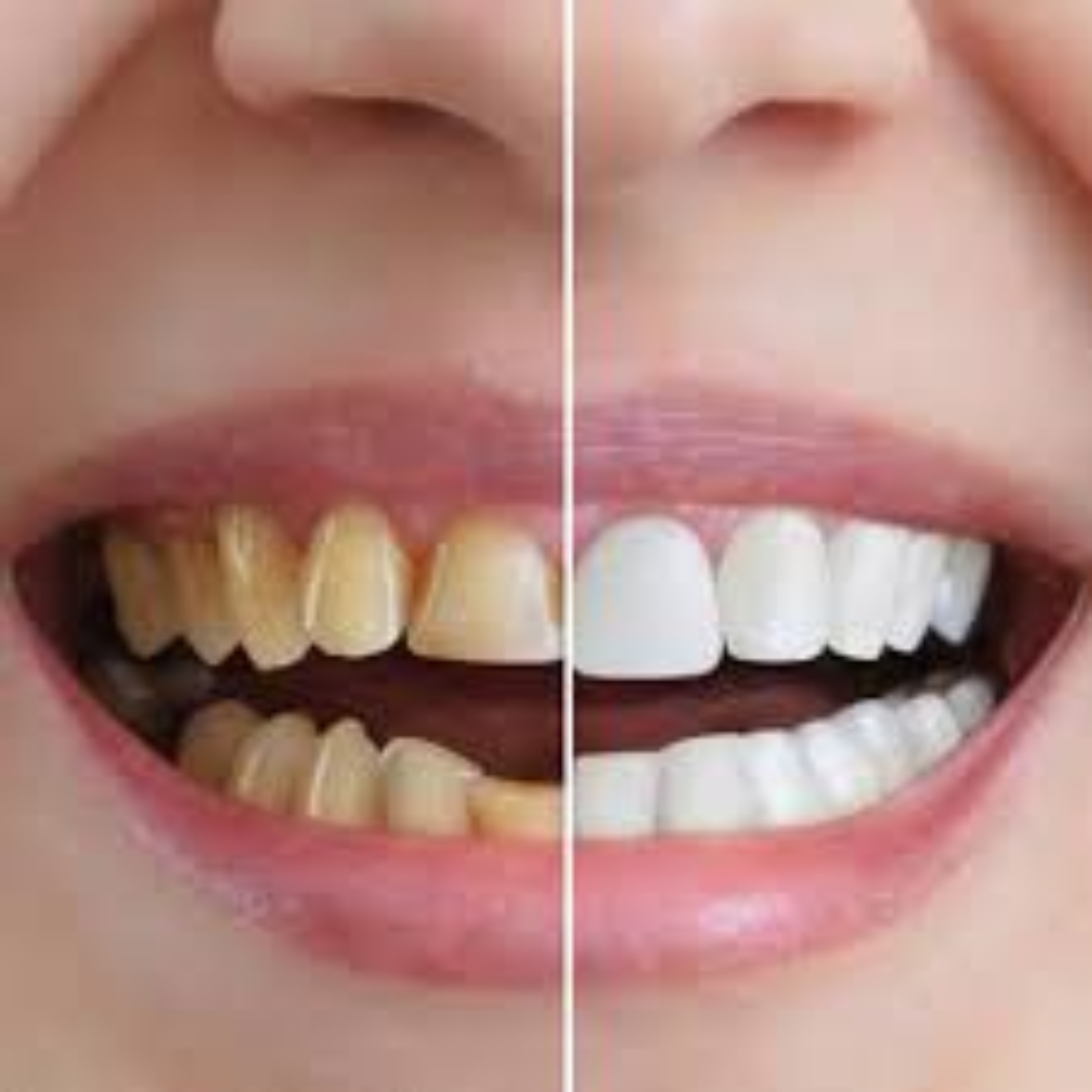 dental impamnt (6)