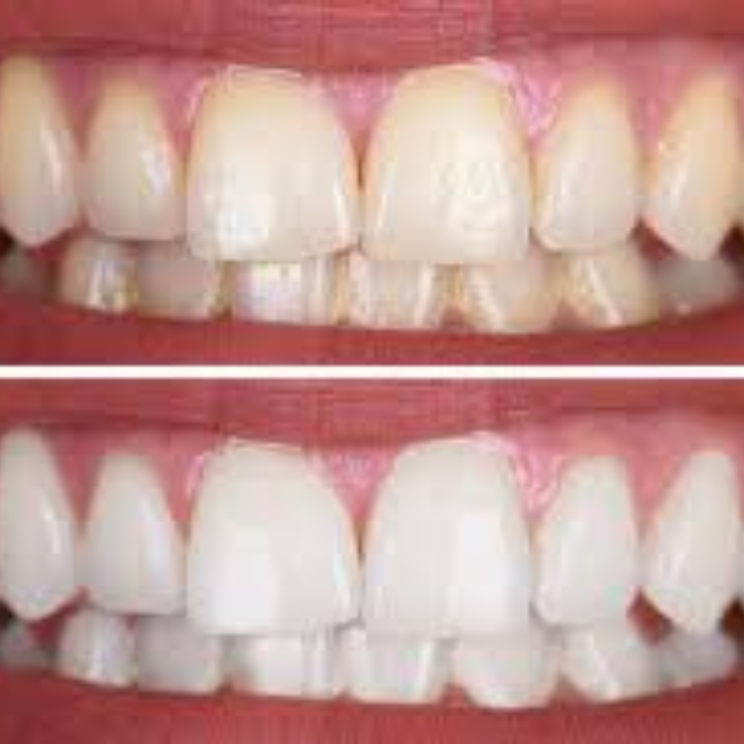 dental impamnt (7)