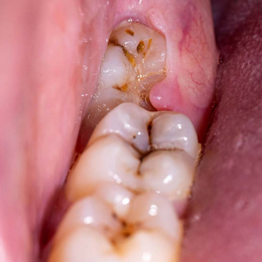 dental impamnt (8)