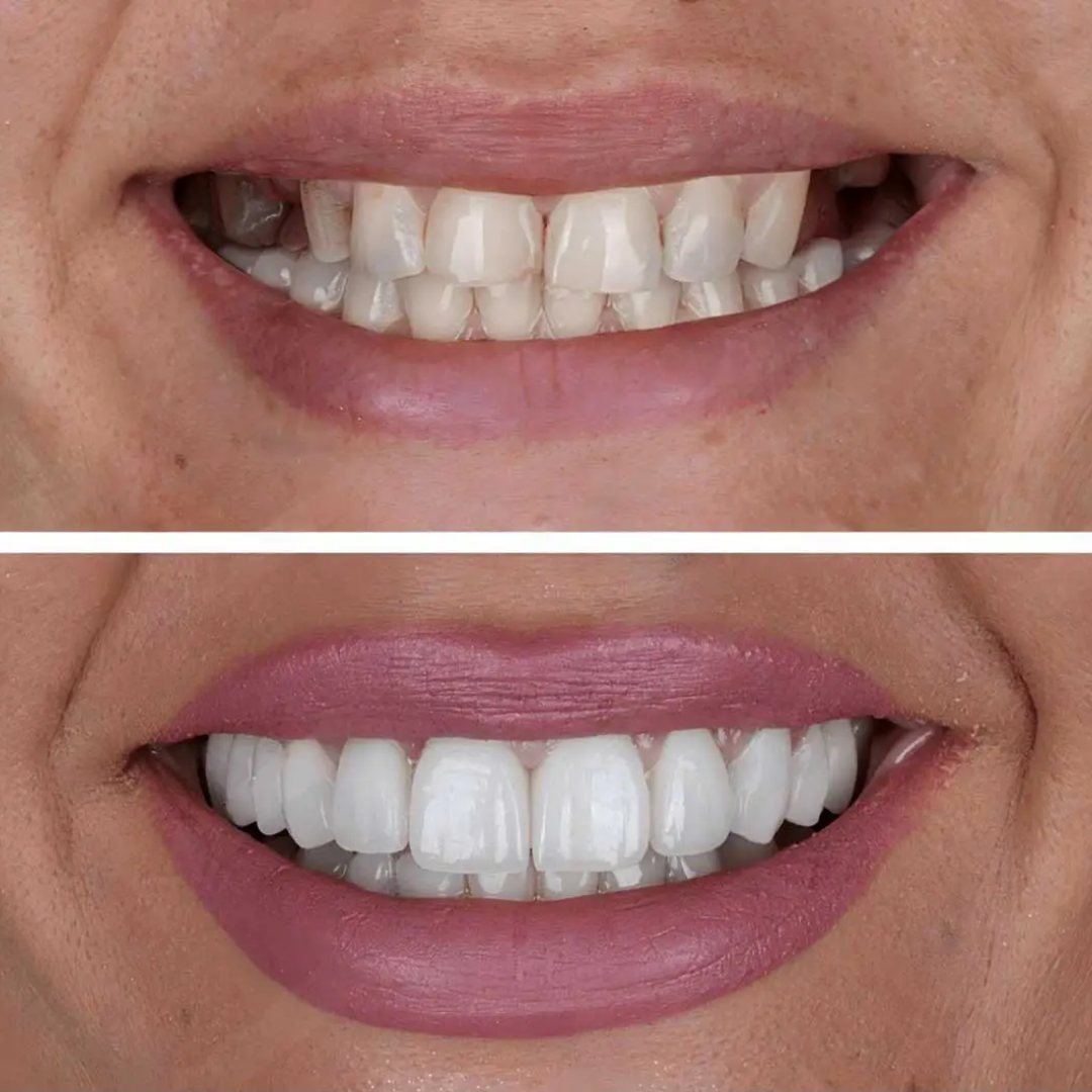 dental impamnt